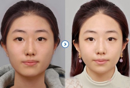 悦丽汇兰州衡力瘦脸针100U 做小脸美人