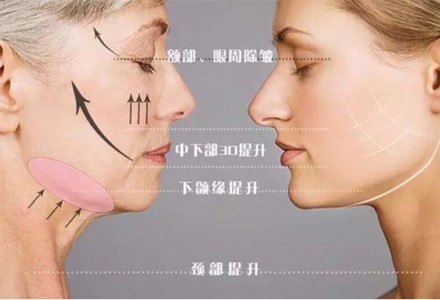 北京4D时光线全脸拉提-