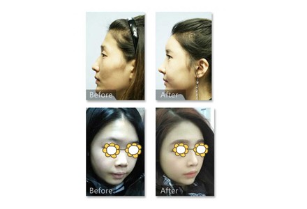 Shine综合鼻雕 拒绝假体 完全自体鼻重塑 