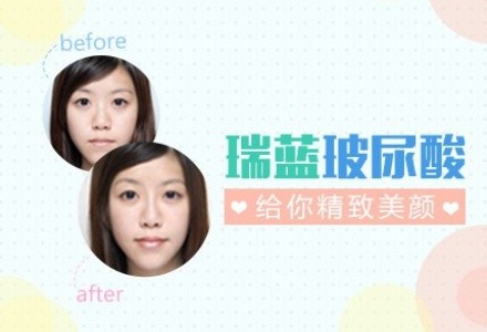 正品进口瑞蓝玻尿酸 让你水润饱满 除皱塑动人脸形