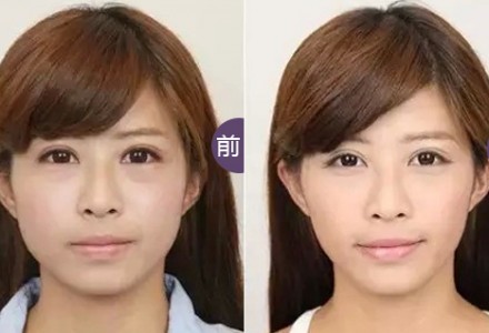 衡力瘦脸针 脸小才能圈子大