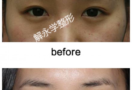 无痕微雕开眼角 让你的眼睛大而有神