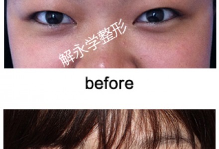 无痕微雕开眼角 让你的眼睛大而有神