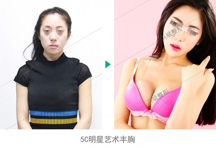 5C明星艺术丰胸 院长专利