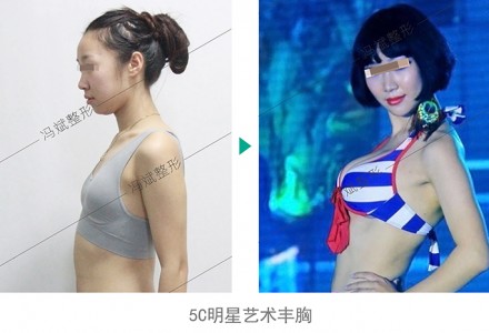 5C明星艺术丰胸 院长专利