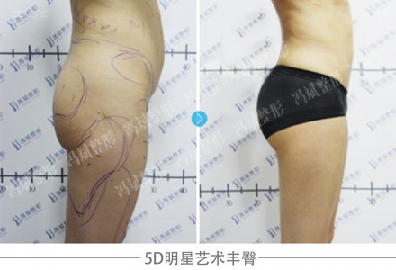 5D明星艺术丰臀 让你拥有动人的臀部曲线