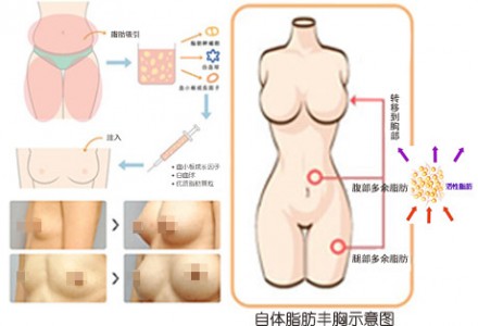 自体脂肪丰胸 给你性感酥胸 不排异手感好