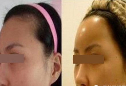 全面部自体脂肪填充 PRP 将丢失的岁月种回来