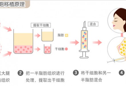 全面部自体脂肪填充 PRP 将丢失的岁月种回来