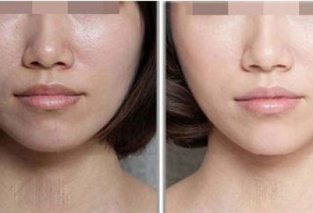 E光嫩肤 比光子嫩肤更好的嫩肤