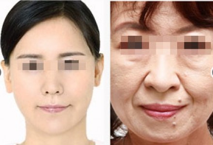 BOTOX肉毒除皱针 抚平皱纹 青春永驻