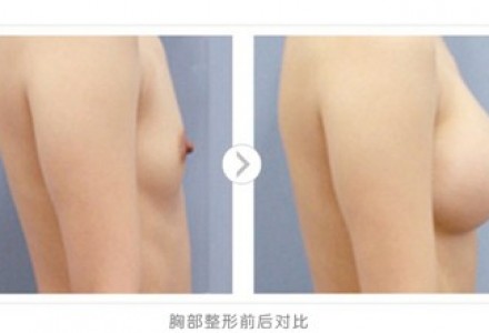 自体脂肪丰胸 告别假体时代双峰自然坚挺