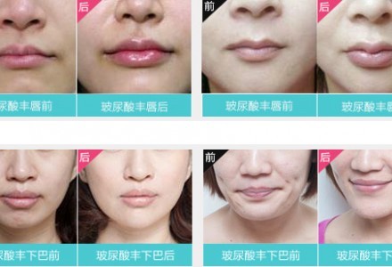伊婉玻尿酸面部填充 拥有明星般的美丽