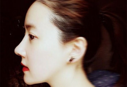 上海韩式生科假体隆鼻-