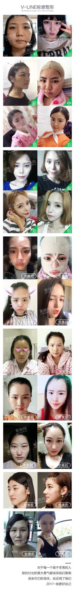 https://img.yiyiaimei.com/mnt/Editor/2017-09-13/59b8c58d14903.jpg 案例图片