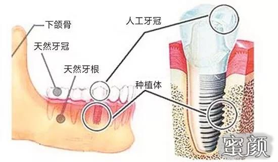 https://img.yiyiaimei.com/mnt/Editor/2020-05-30/5ed21b32c9e31.jpg 案例图片