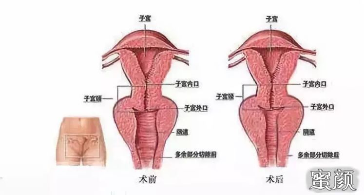 宫颈裂伤分度及示意图图片