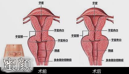 宫颈内口松弛图片图片