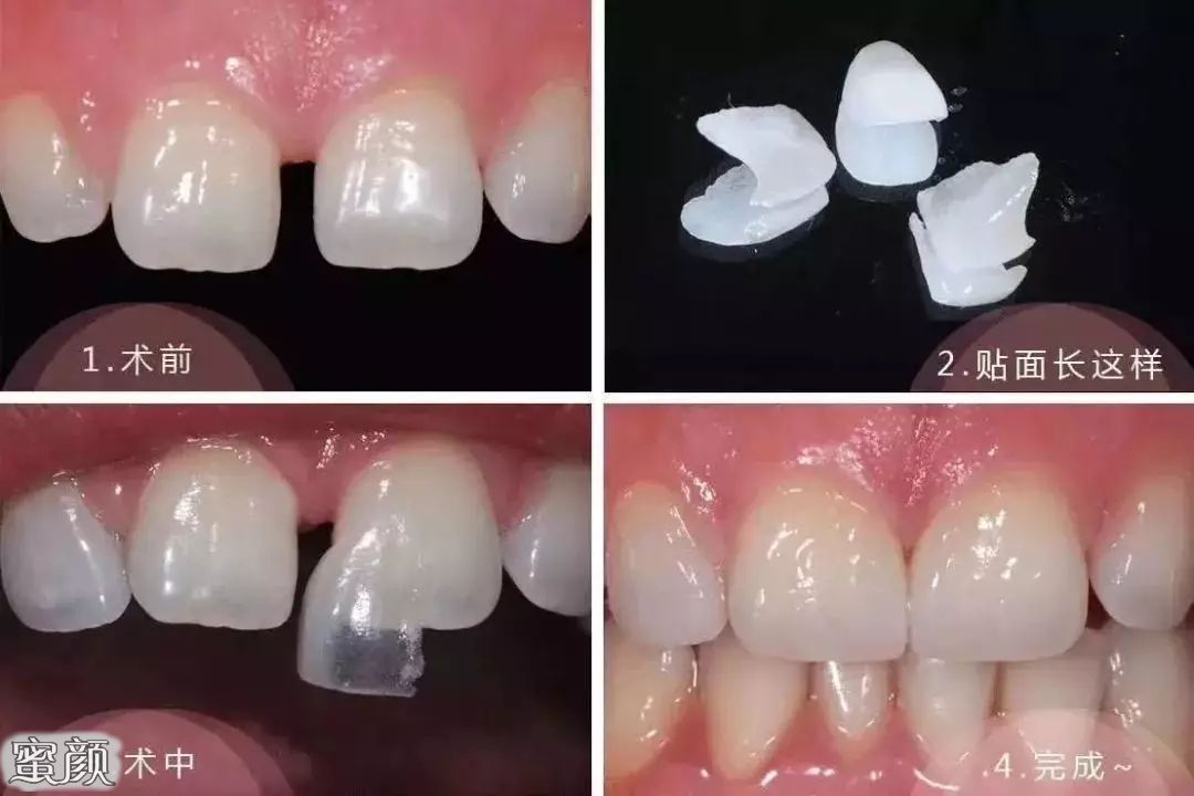 夜磨牙疾病(2)牙齿缺损过大,没有足够的粘结面(1)过度咬合二,瓷贴面修