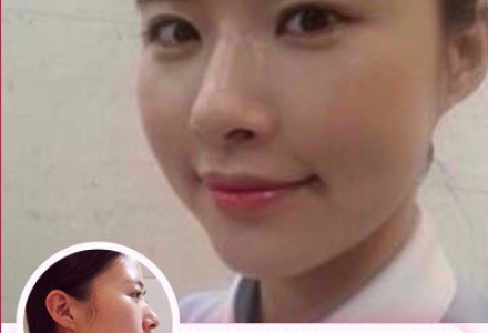 爱芙莱玻尿酸 无痛微整 塑型更强