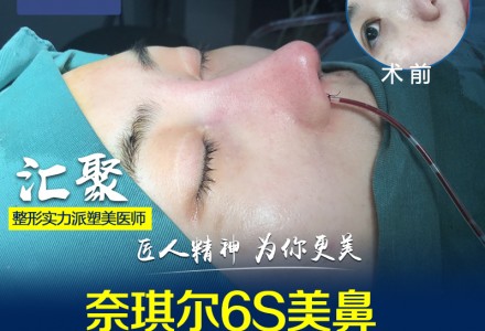 广州晨曦鼻综合-
