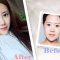 微创双眼皮+开内眼角  一次手术 搞定双眼