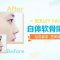 达拉斯自体软骨隆鼻 抬高鼻梁 塑美鼻尖