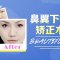 鼻翼下垂矫正术 给鼻子做个提升 为自己的气质加分