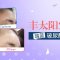 玻尿酸打造饱满福气宫 修饰面容轮廓