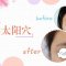 玻尿酸帮你填平太阳穴凹陷 饱满旺夫惹人爱