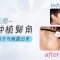FUE无痕植发重塑靓丽鬓角 彰显帅气时尚