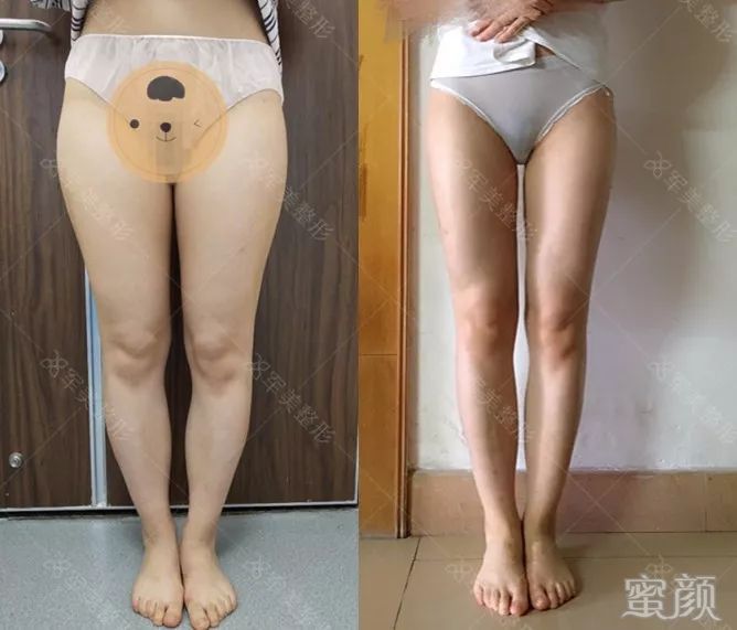 https://img.yiyiaimei.com/mnt/timg/200119/140333B54-7.jpg 案例图片