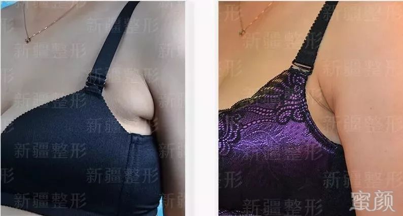https://img.yiyiaimei.com/mnt/timg/200120/122123A62-7.jpg 案例图片