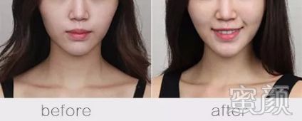 https://img.yiyiaimei.com/mnt/timg/200120/1322033M6-3.jpg 案例图片