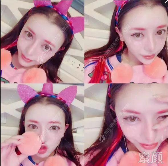 https://img.yiyiaimei.com/mnt/timg/200202/1444035615-9.jpg 案例图片