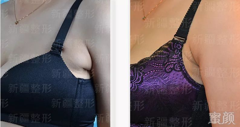 https://img.yiyiaimei.com/mnt/timg/200210/135F933C-4.jpg 案例图片