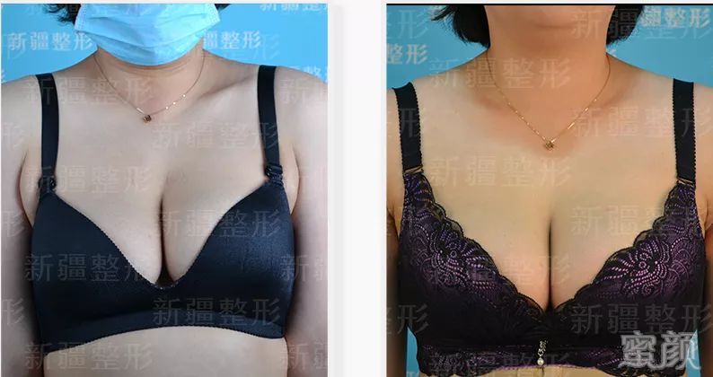 https://img.yiyiaimei.com/mnt/timg/200210/135FS115-3.jpg 案例图片