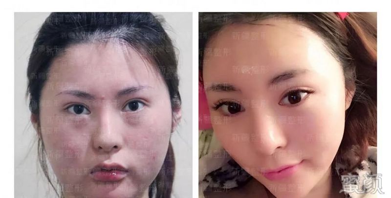 https://img.yiyiaimei.com/mnt/timg/200210/135G05M5-6.jpg 案例图片