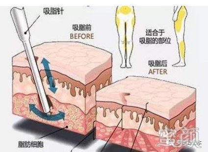 https://img.yiyiaimei.com/mnt/timg/200215/1410042F2-2.jpg 案例图片