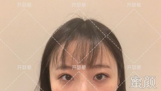 https://img.yiyiaimei.com/mnt/timg/200216/1350203101-0.jpg 案例图片