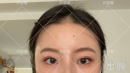 https://img.yiyiaimei.com/mnt/timg/200216/135022F20-2.jpg 案例图片
