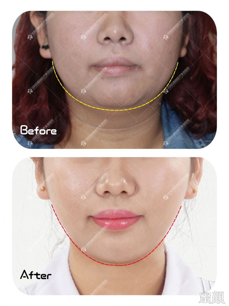 https://img.yiyiaimei.com/mnt/timg/200222/134SWI4-13.jpg 案例图片