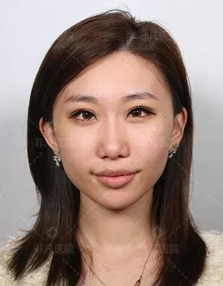https://img.yiyiaimei.com/mnt/timg/200225/13514V507-12.jpg 案例图片