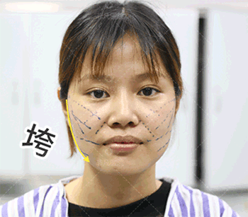 https://img.yiyiaimei.com/mnt/timg/200225/13514aE1-14.jpg 案例图片