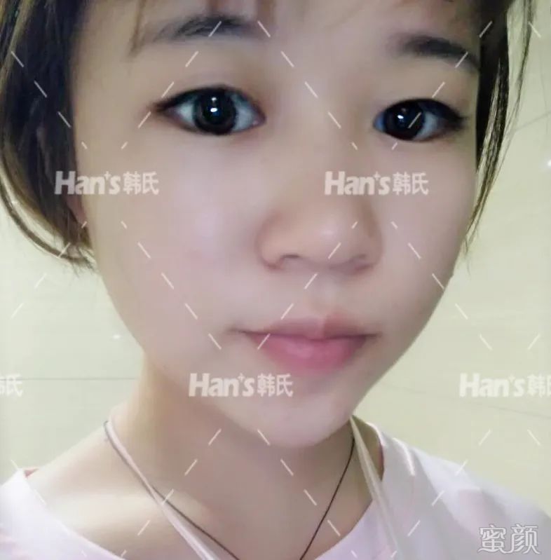 https://img.yiyiaimei.com/mnt/timg/200228/12594KB8-1.jpg 案例图片