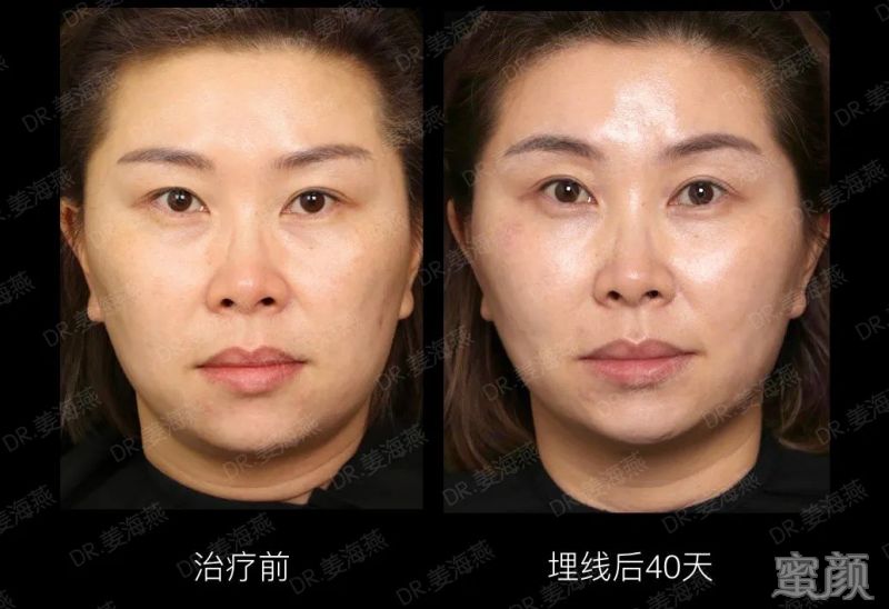 https://img.yiyiaimei.com/mnt/timg/200304/1309191b9-12.jpg 案例图片