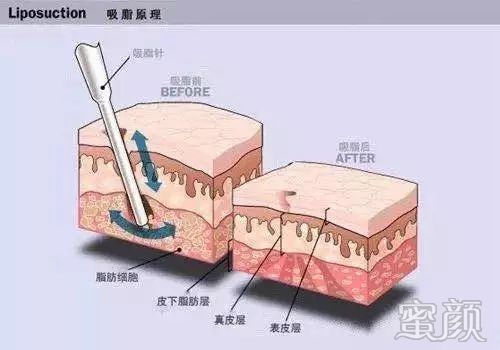 https://img.yiyiaimei.com/mnt/timg/200307/14140150W-9.jpg 案例图片