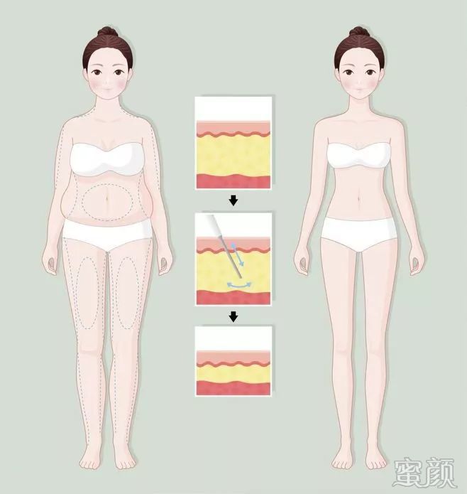https://img.yiyiaimei.com/mnt/timg/200311/13145AN0-4.jpg 案例图片