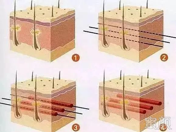 https://img.yiyiaimei.com/mnt/timg/200312/13351H327-4.jpg 案例图片