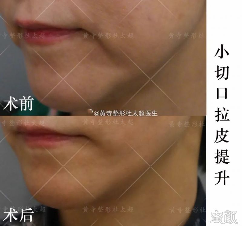 https://img.yiyiaimei.com/mnt/timg/200313/125K15306-4.jpg 案例图片